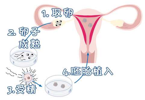 多囊卵巢案例